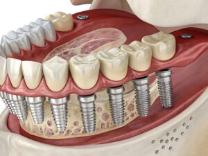 Dental implant model showing full arch restoration