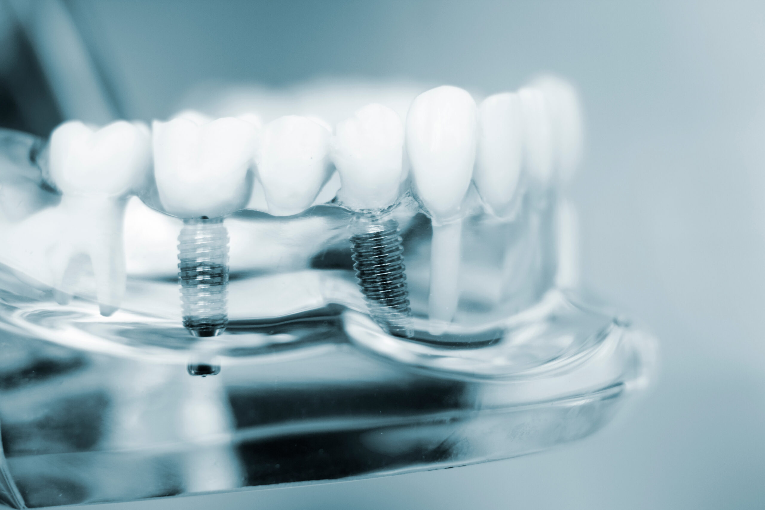 Dental implant model showing titanium post and crown for tooth replacement