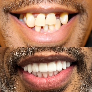 Full mouth reconstruction before and after results – Manhattan Aesthetic Dentistry with Dr. Nargiz Schmidt, DDS